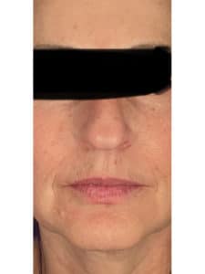 After Image: Botox