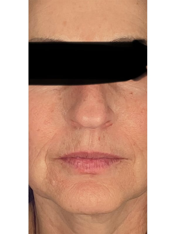 After Image: Botox - front