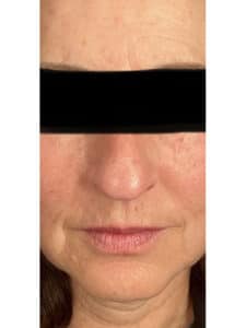 Before Image: Botox