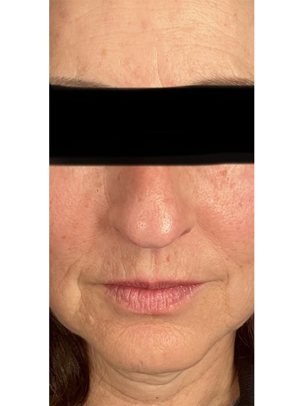 Before Image: Botox - front