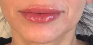 After Image: Juvederm
