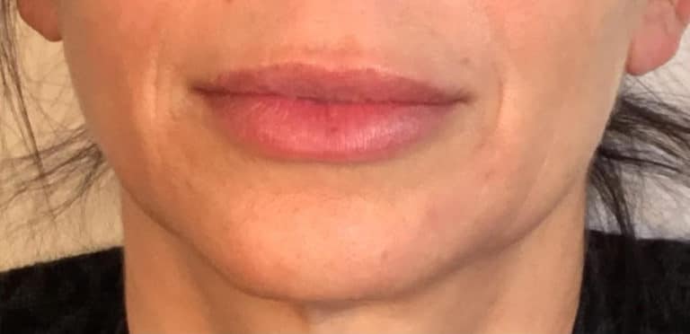 Before Image: Juvederm - front
