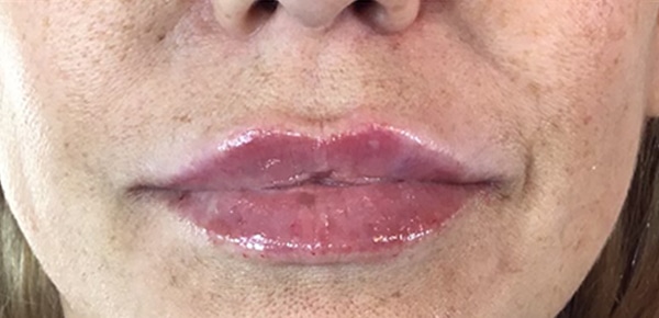 After Image: Juvederm - front