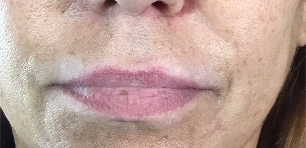 Before Image: Juvederm - front