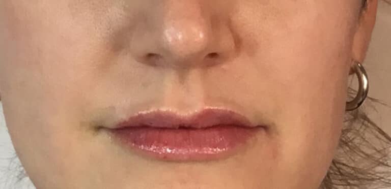 After Image: Juvederm - front
