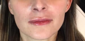 After Image: Juvederm