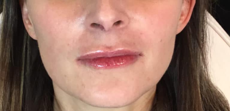 After Image: Juvederm - front