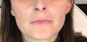 Before Image: Juvederm