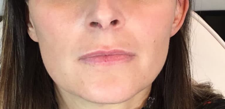 Before Image: Juvederm - front