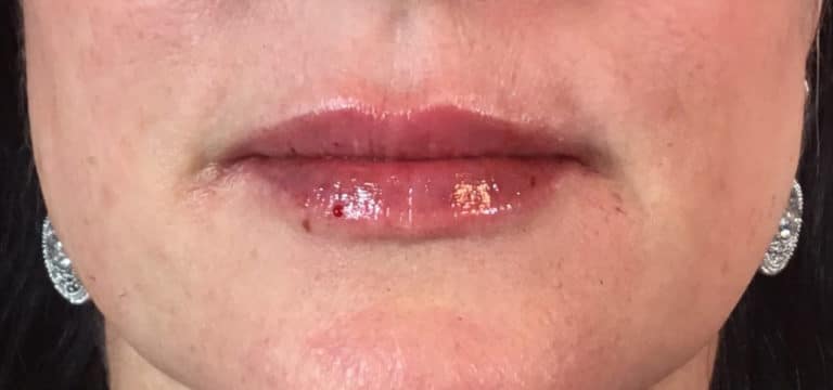 After Image: Juvederm - front