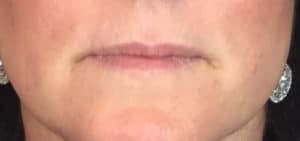 Before Image: Juvederm