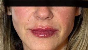 After Image: Juvederm