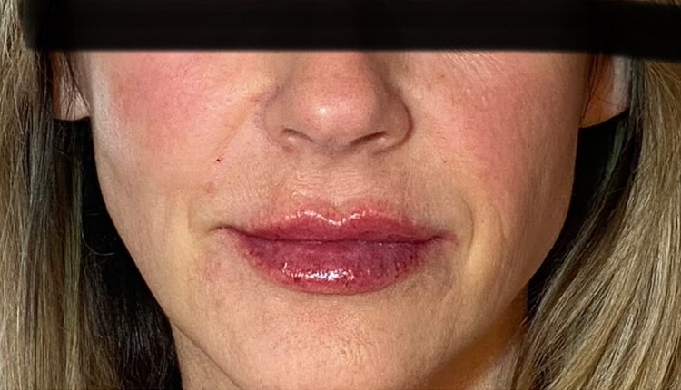 After Image: Juvederm - front