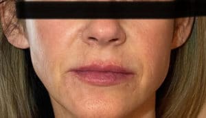 Before Image: Juvederm