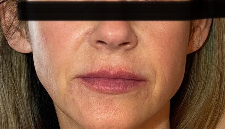 Before Image: Juvederm - front