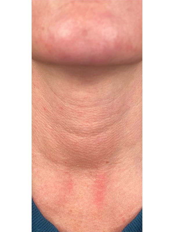 Before Image: Radiesse+PRF - front