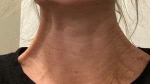 After Image: Botox
