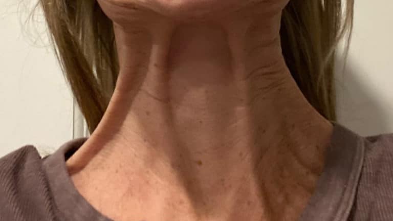 Before Image: Botox - front